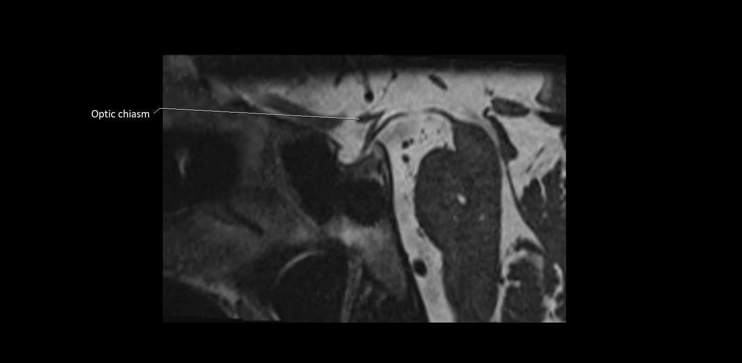 Cranial nerve sagittal anatomy MRI 3T image 31.webp